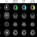 Evaluation of Diffusion Lesion Volume Measurements in Acute Ischemic Stroke Using Encoder-Decoder Convolutional Network (Impact factor(JCR 2018) : 6.046)
